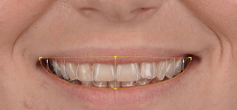 Visualisierung der geplanten Zahnkorrekturen durch Digital Smile Design
