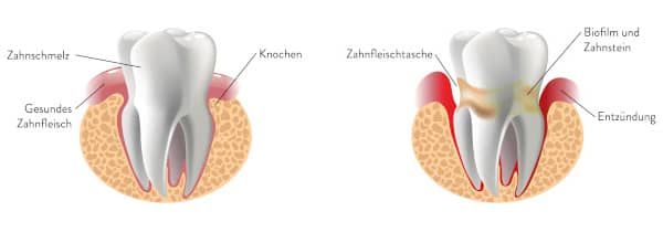 Schemadarstellung: Parodontitis