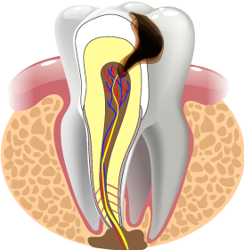 Schemadarstellung: Wurzelentzündung