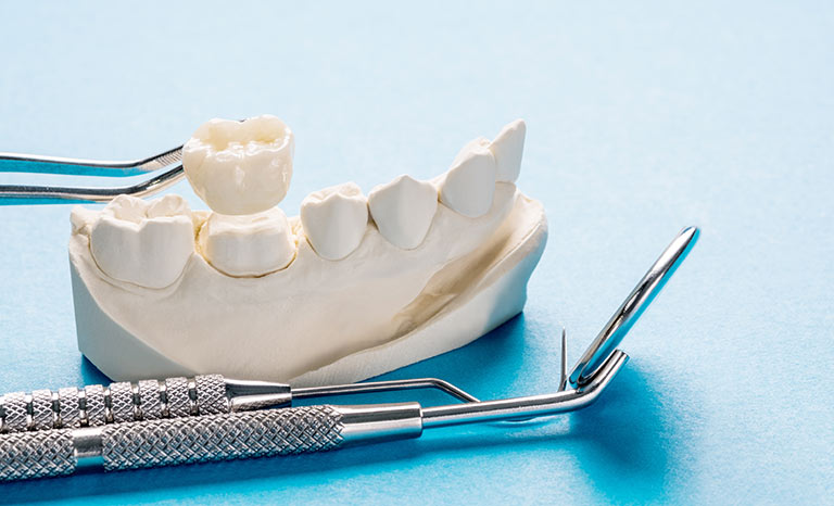 Keramik-zahnersatz neben einem Abdruck-Modell eines Unterkiefers