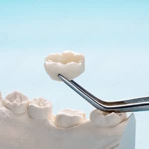 Keramik-Zahnersatz für ein ästhetisches Ergebnis